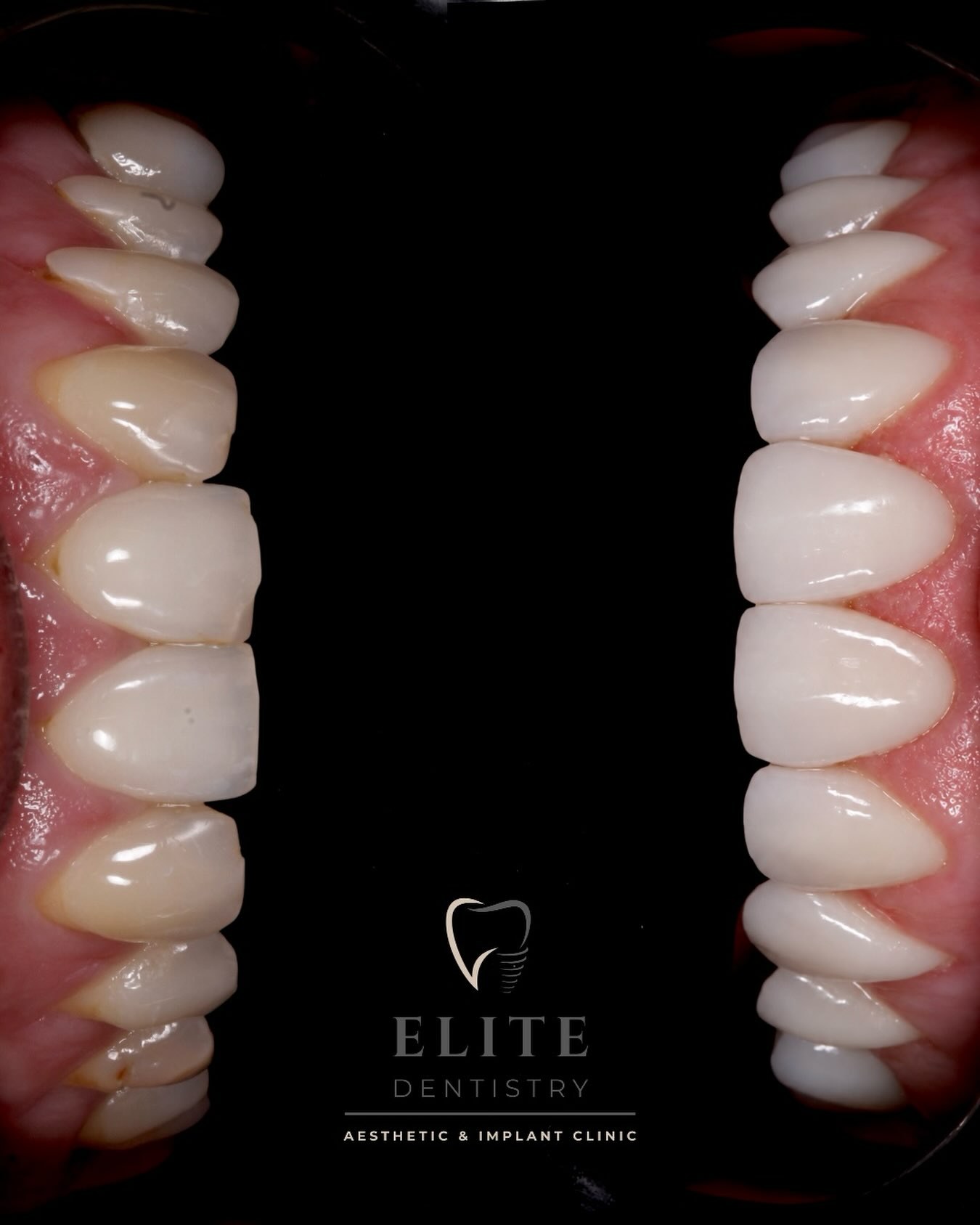 Porcelain veneer smile makeover