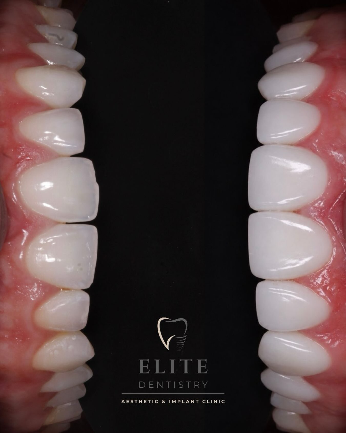 Composite bonding result after whitening