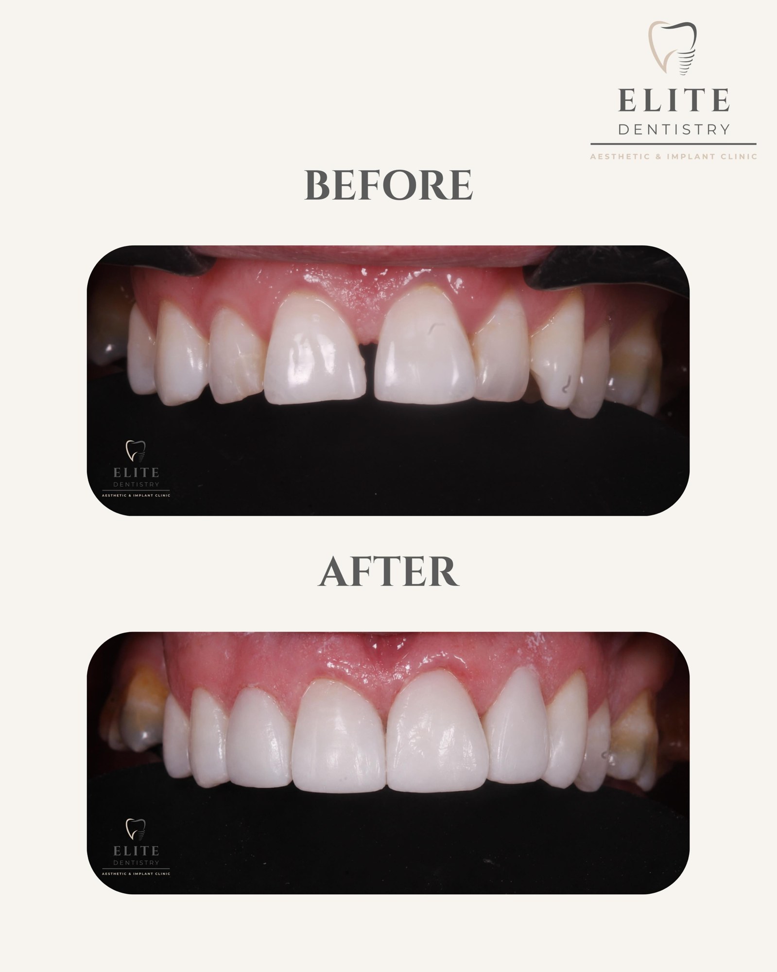 Before and after: upper four porcelain veneers