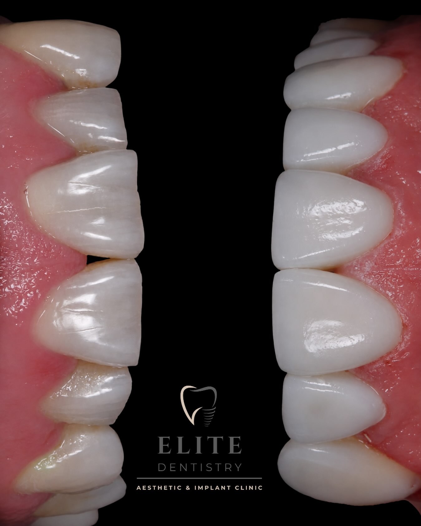 Composite bonding on chipped, worn teeth