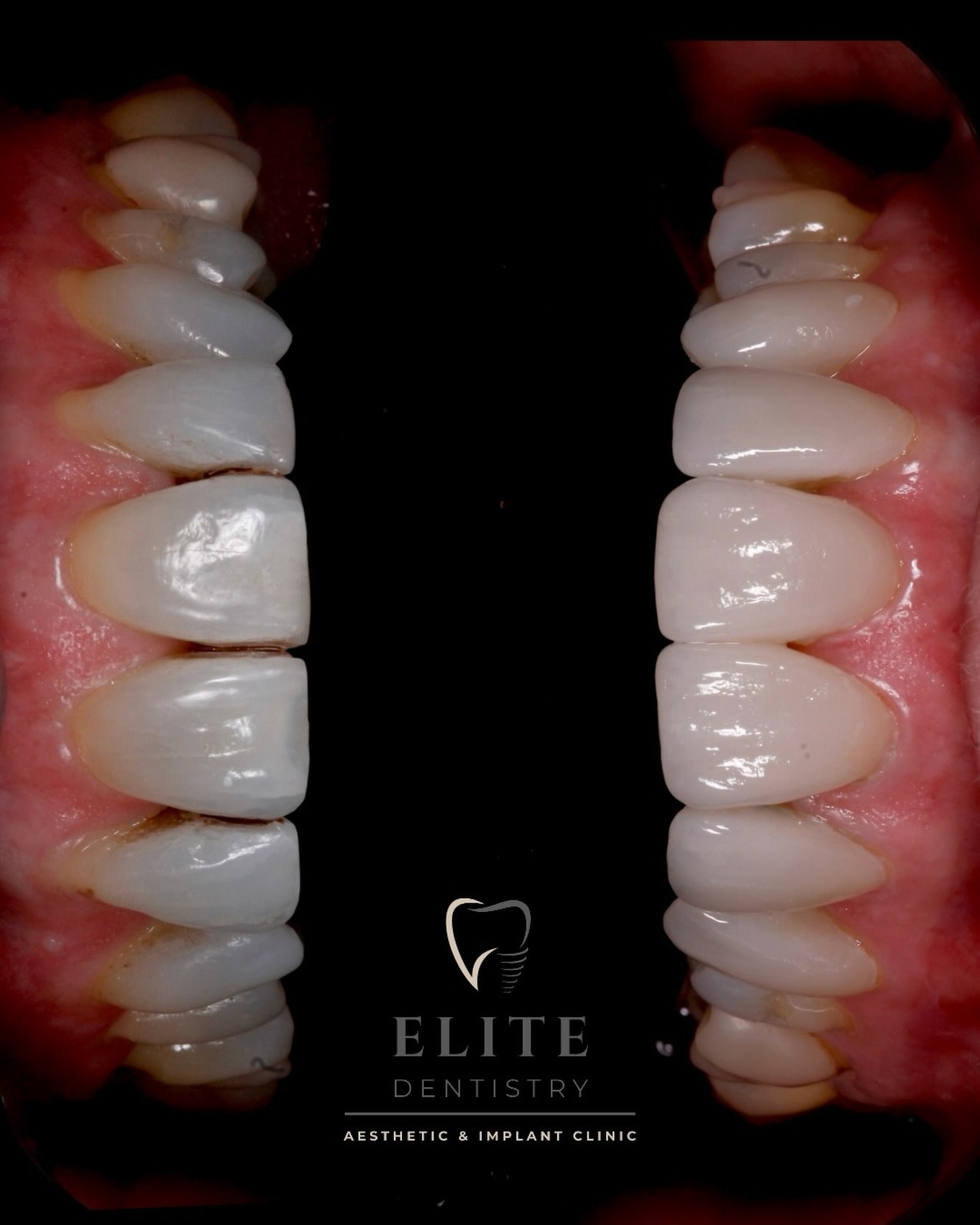 Close-up of a natural porcelain veneer smile