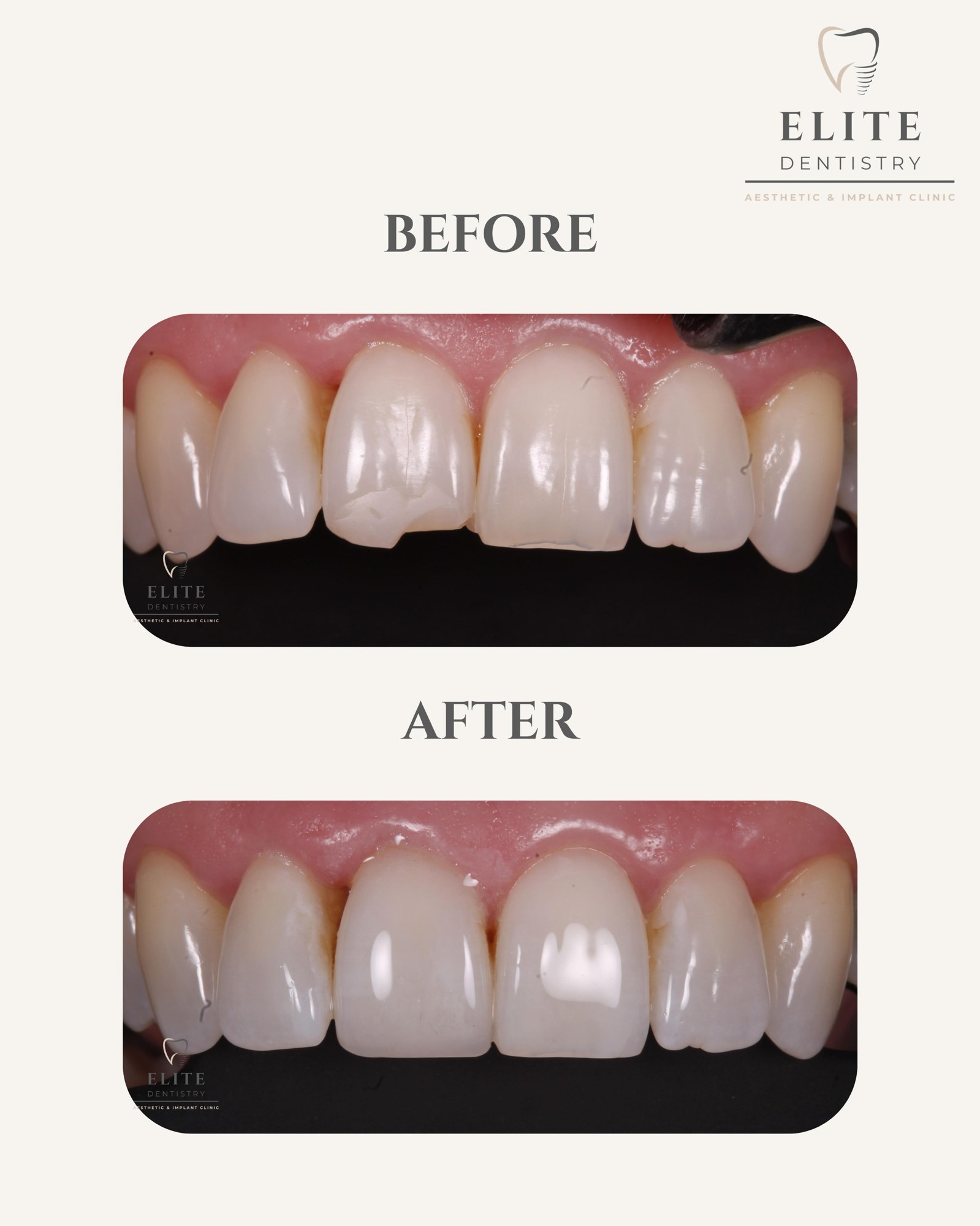 Before and after: 10 porcelain veneers