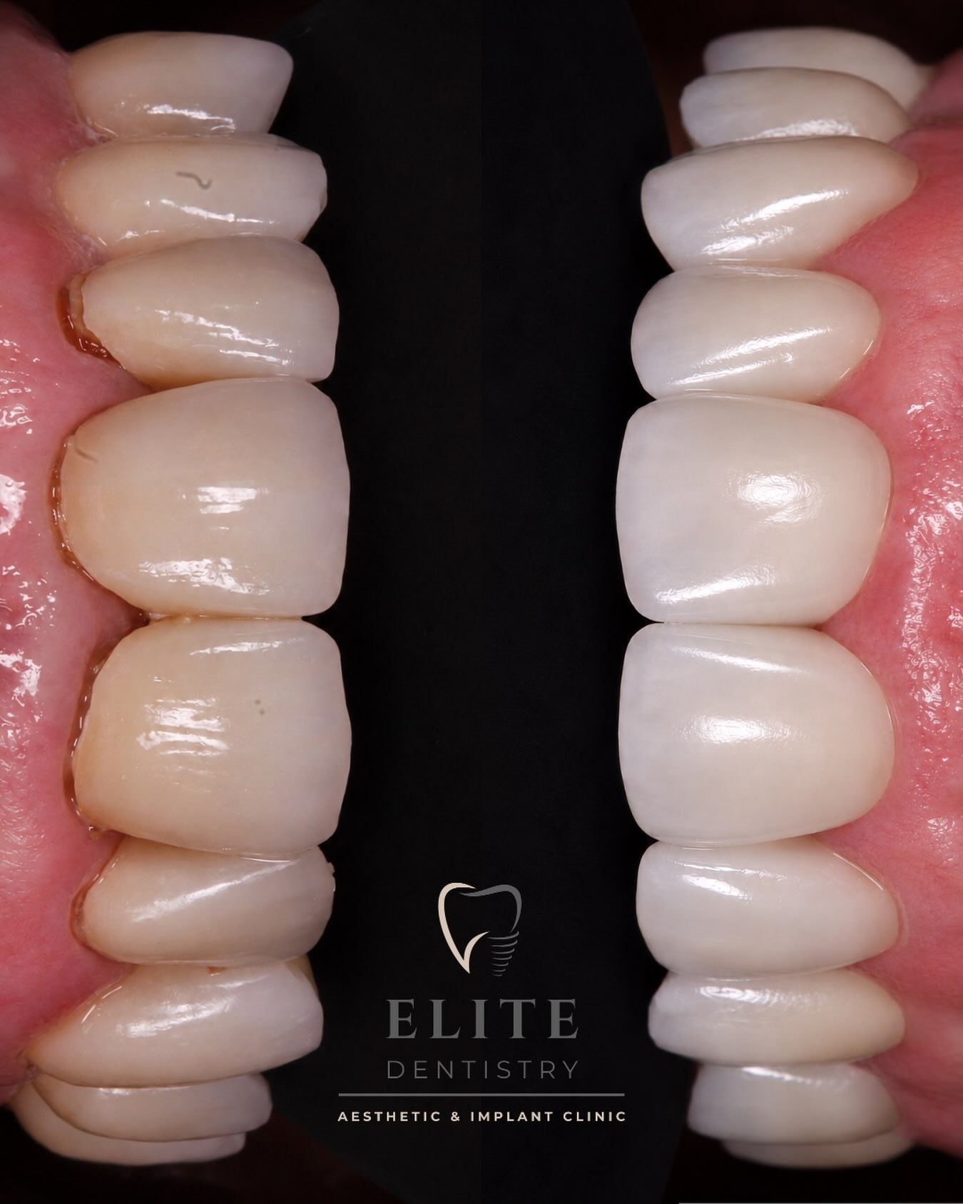 Natural-looking ceramic crowns