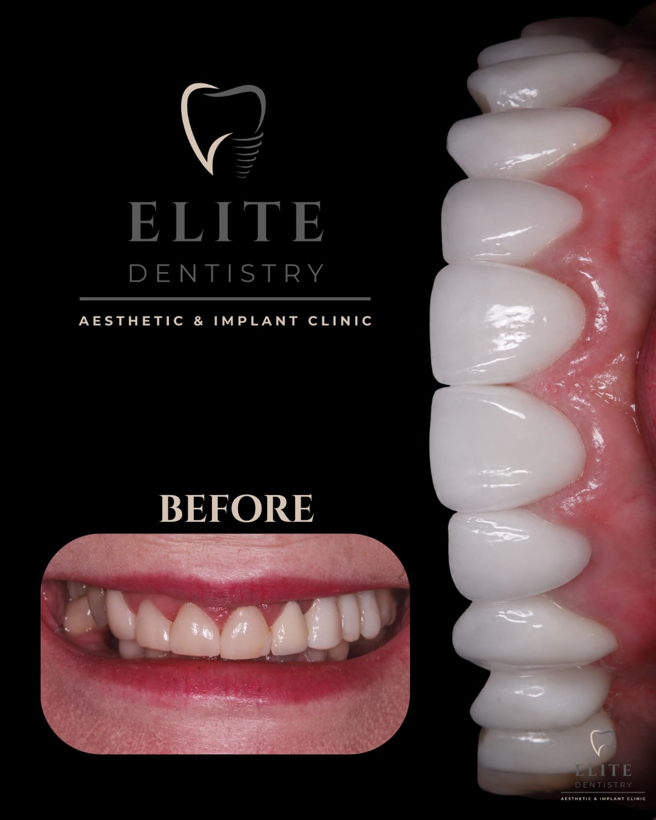 Before and after: full upper arch ceramic crowns